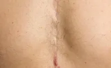 Aortenaneurysma-Screening