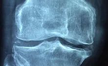 Osteoporose-Screening