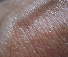 Hautkrebs-Screening